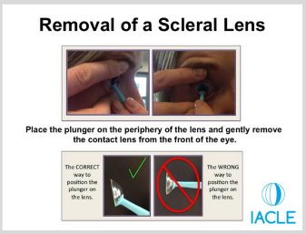 <p>1. Aim for the lower half of the lens with the plunger. </p><p>2. Once the plunger is sucked on, make a movement away from the eye, and upward. This will break the seal and the lens can easily be removed. </p><p>3. Lift the lens edge from the eye</p>
