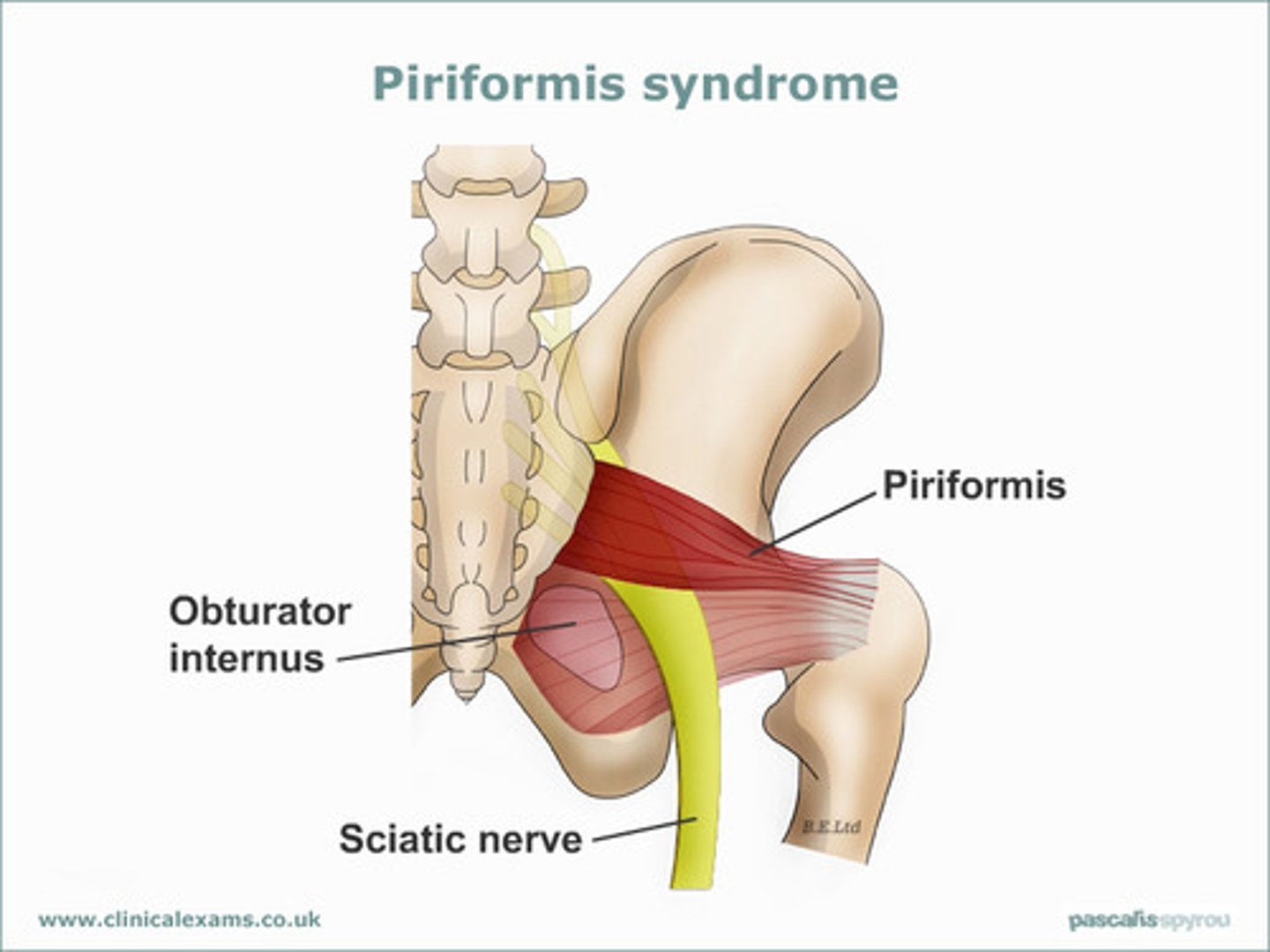 <p>- tight piriformis muscle (resulting from repetitive contraction of gluteal muscles in sports like skating,cycling)</p><p>- may impinge on sciatic nerve, more common in anomalies where sciatic nerve penetrates piriformis muscle</p><p>- presents with pain in gluteal region; referred to groin, leg; intolerance to sitting</p>
