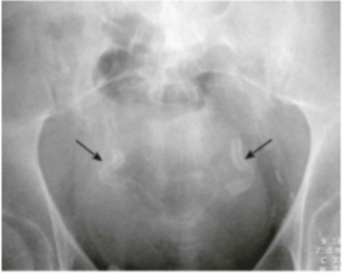 <p>calcification in the walls of tubular structures</p><p>ex. arteries, ureters, fallopian tubes, vas deferens</p><p>walls of veins do not calcify</p>