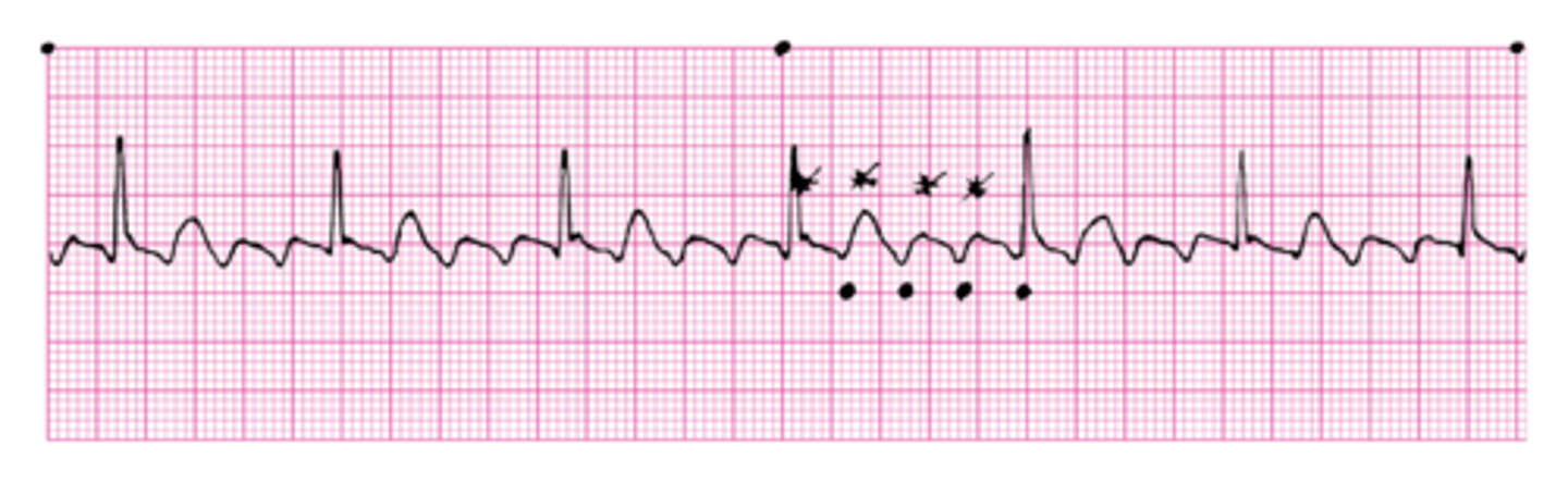 <p>Rate: 200-350</p><p>Cause: Pulmonary embolus, valvular heart disease, lung disease, thyrotoxicosis, heart failure</p><p>Clinical sig: Decreased cardiac output, heart failure, clots</p><p>Treatment: calcium channel blockers and/or beta-blockers first, adenosine, antiarrhythmics (amiodarone, flecainide) cardioversion, ablation (tx of choice) </p>