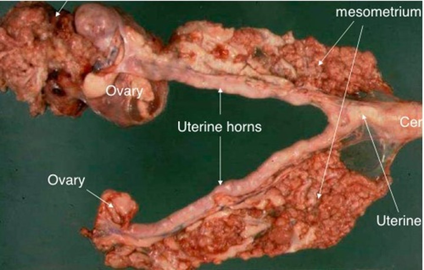 <p>malignant tumor of the ovary</p>