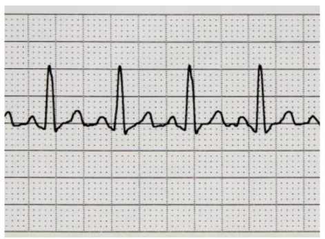 <p>what is the heart rate (round up) (12 small squares)</p>