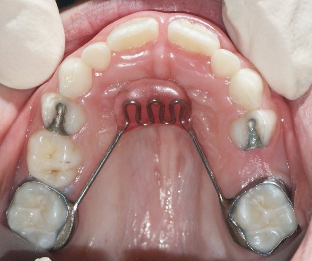 <p>Prevent teeth from moving</p><p>Use to expand or rotate upper molars</p>