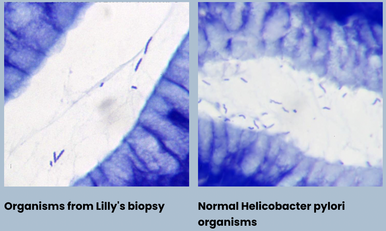 <p>H.pylori infection - H.pylori normally V-shaped: seagull shape and more bendy and curvy</p><p>Infection: lot straighter and coiled tighter and thicker </p>
