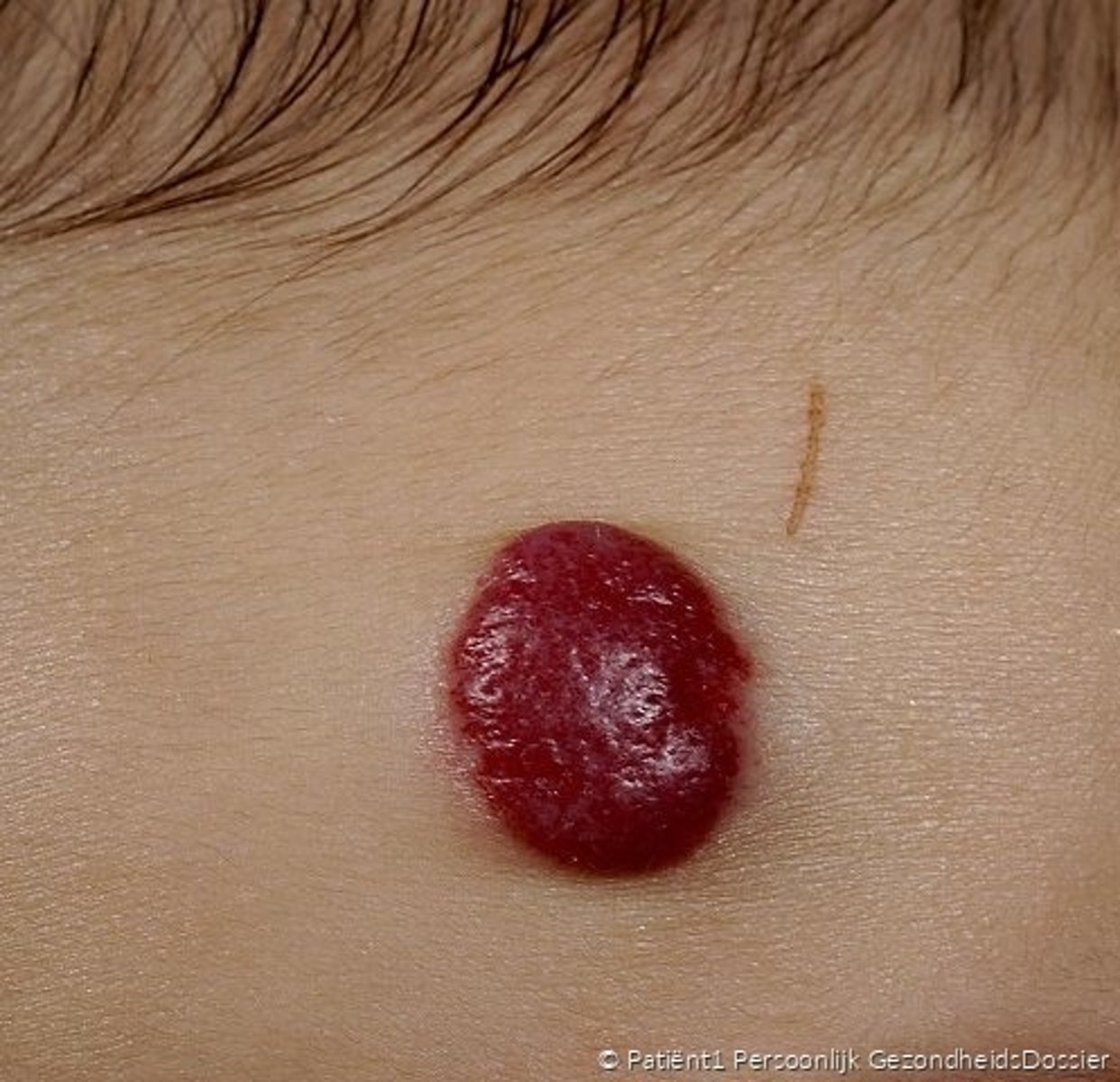 <p>= goedaardige tumor van de huid die ontstaat uit endotheelcellen van de bloedvaten. Deze is direct na de geboorte of enkele weken erna zichtbaar.</p><p>- prevalentie: 1-2%</p>