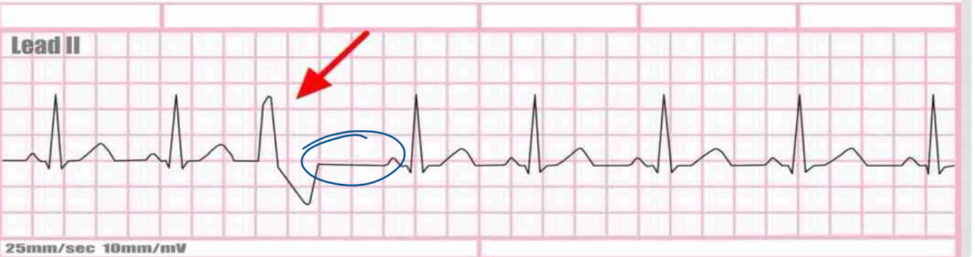 <p>EKG</p>