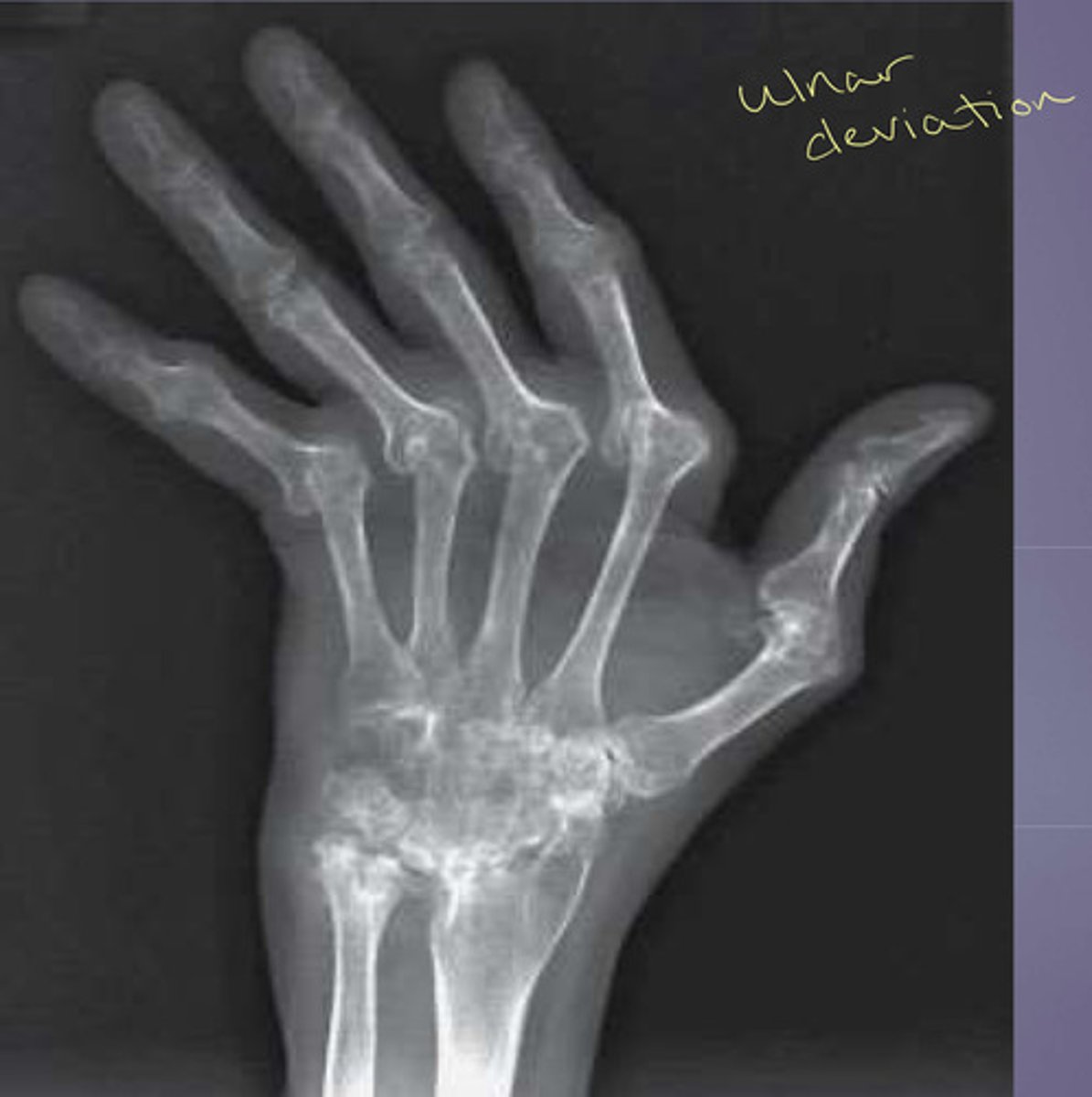 <p>Ulnar deviation</p>