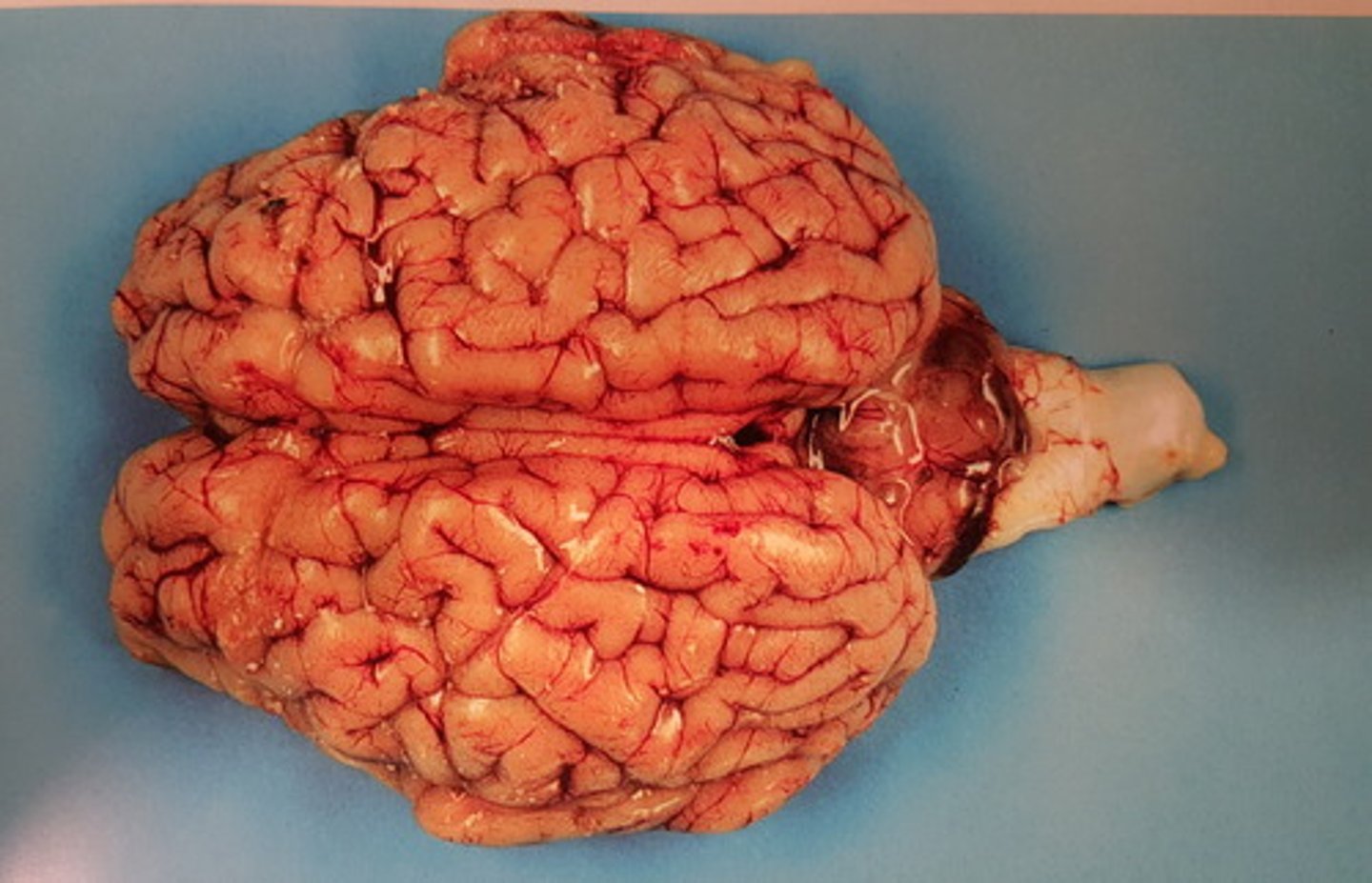 <p>Hjerne fra okse. Patoanatomisk diagnose? Hvad er ofte ætiologi?</p>