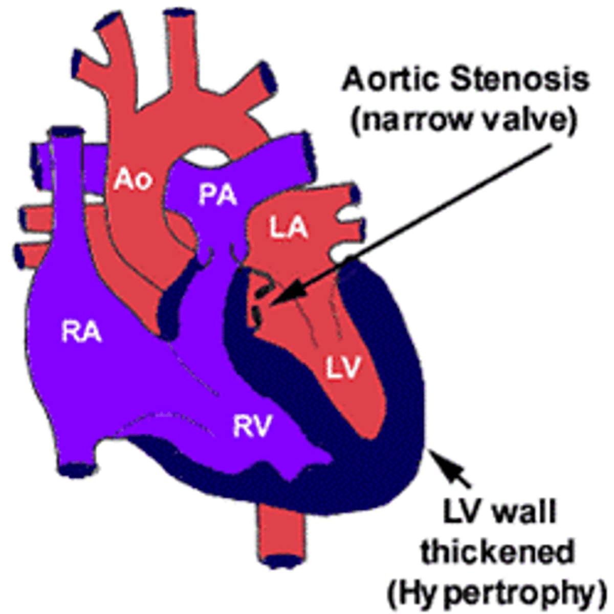 <p>narrowing of the aortic valve</p>