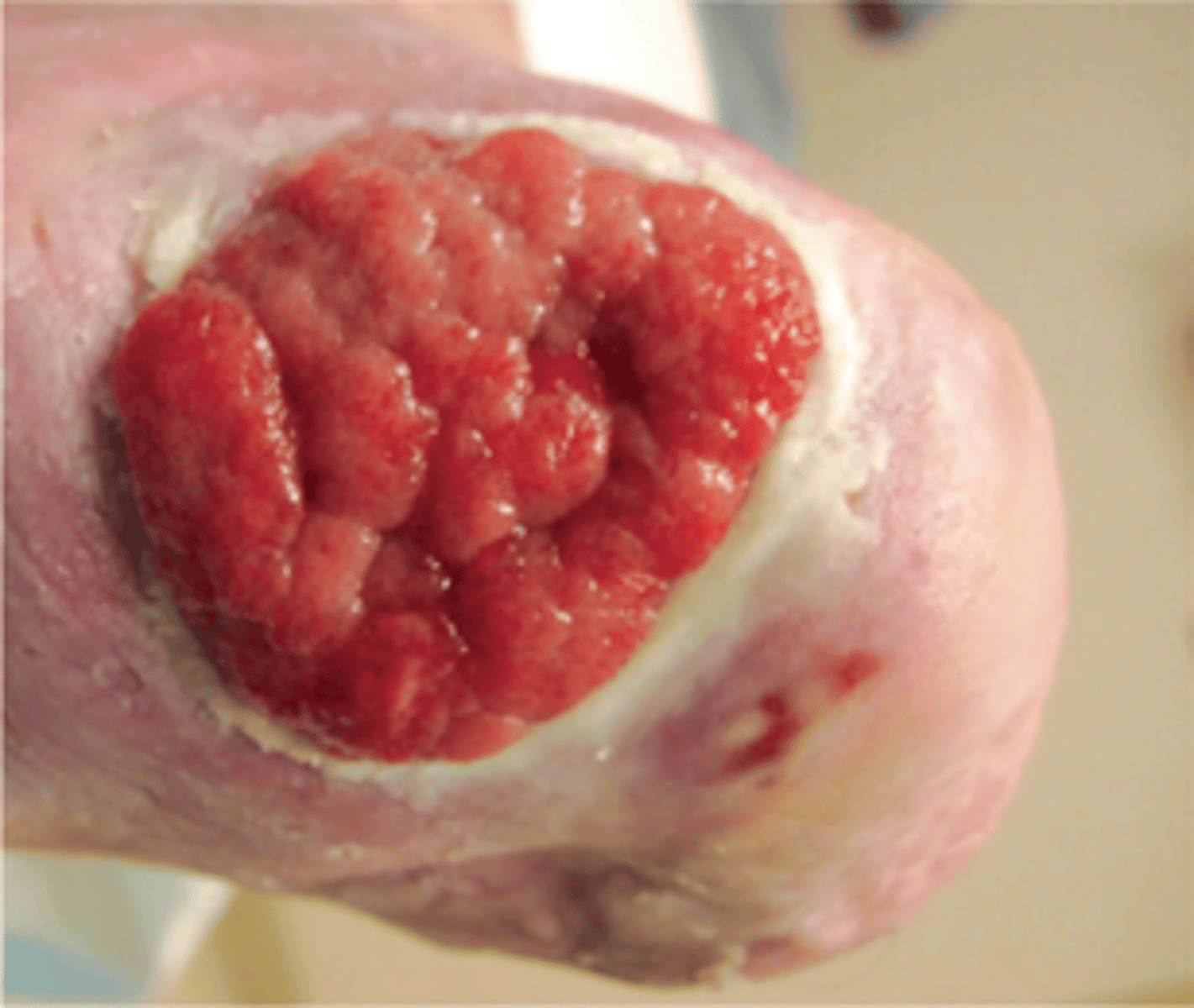 <p>WOUND BED ASSESSMENT</p><p>granulation tissue that overgrows above the edges of the epithelializing tissue</p><p>*often due to infection or excessive moisture</p><p>**will impede healing unless treated</p>