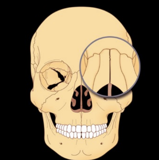 <p>What type of suture</p>