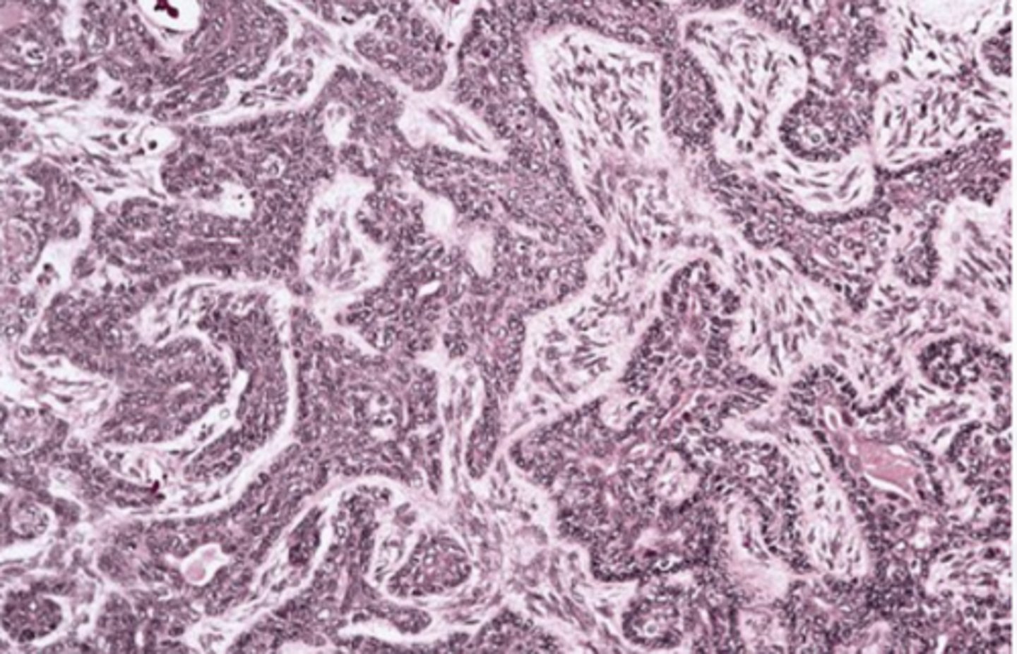 <p>These histologic characteristics are indicative of what oral pathology?</p><p>Encapsulated Islands with palisaded cells or Jigsaw pattern </p><p>May form ducts</p>