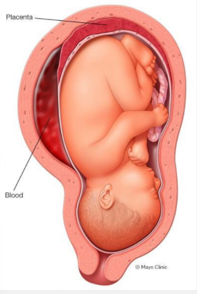 <p><strong>Placental Abruption: Acute Severe Abruption</strong></p><p>-High-pressure arterial ____________ in the placenta dissects through the placental-decidual interface and causes ________ or nearly complete placental separation</p><p>-A small proportion of abruptions are due to </p><ul><li><p>Sudden mechanical events </p></li><li><p>Rapid uterine ____________</p></li><li><p>Due to strain between the pliable myometrium and the inelastic placenta </p></li><li><p>In MVAs, rapid acceleration-deceleration of the uterus causes uterine ______ exceeding concomitant placental _______ → leads to shearing force between the placenta and uterine wall </p></li></ul><p></p>
