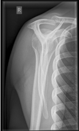 <p>is this a normal or dislocated shoulder? how do you know? </p>