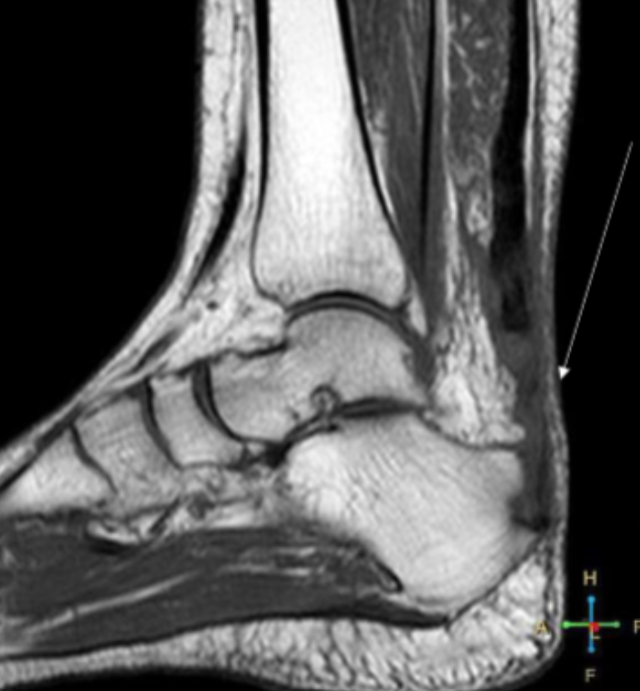 <p>Describe the pathology indicated by the arrow (Sag PD). </p>