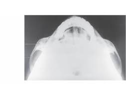 The zygomatic arches
