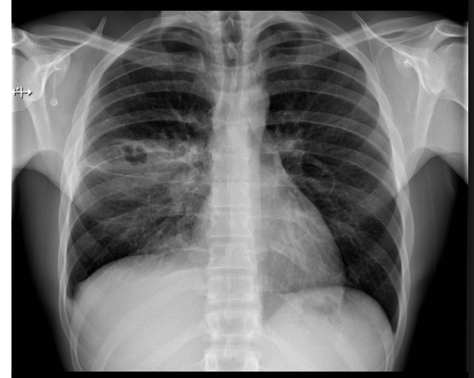 <p>67 y/o pt. presents to the ER with flu like symptoms. Patient reports pleuritic chest pain and a cough with sputum. They report they had a stroke 2 years ago and is diagnosed with COPD. They are allergic to penicillin. Vitals are stable with an exception of a 103.4 temp, 134 bpm, O2 sat is 93% on RA, and 24 RR. While conducting a physical you find inspiratory crackles and bronchial breath sounds, as well as a dullness to percussion. CXR shows patchy airspace opacities and lobar consolidations. What medications do you want to use?</p>