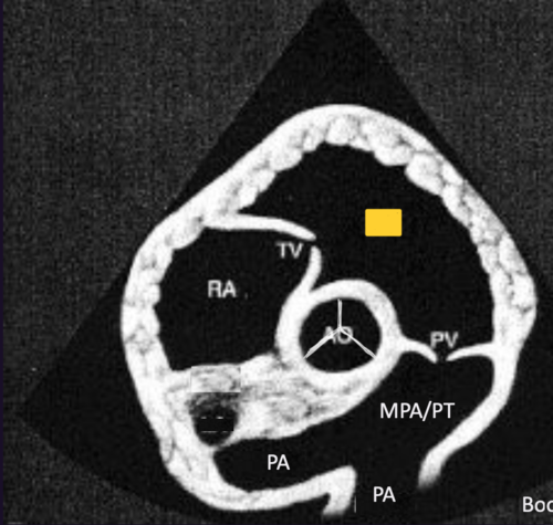 <p>Right Parasternal Short Axis View&nbsp;@ pulmonic valve</p>