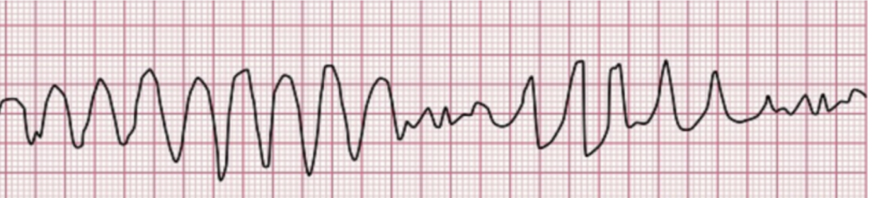 <p><span style="font-family: Lato Extended, Lato, Helvetica Neue, Helvetica, Arial, sans-serif">Identify! what precipitates them, and their medical and nursing management and treatment</span></p>