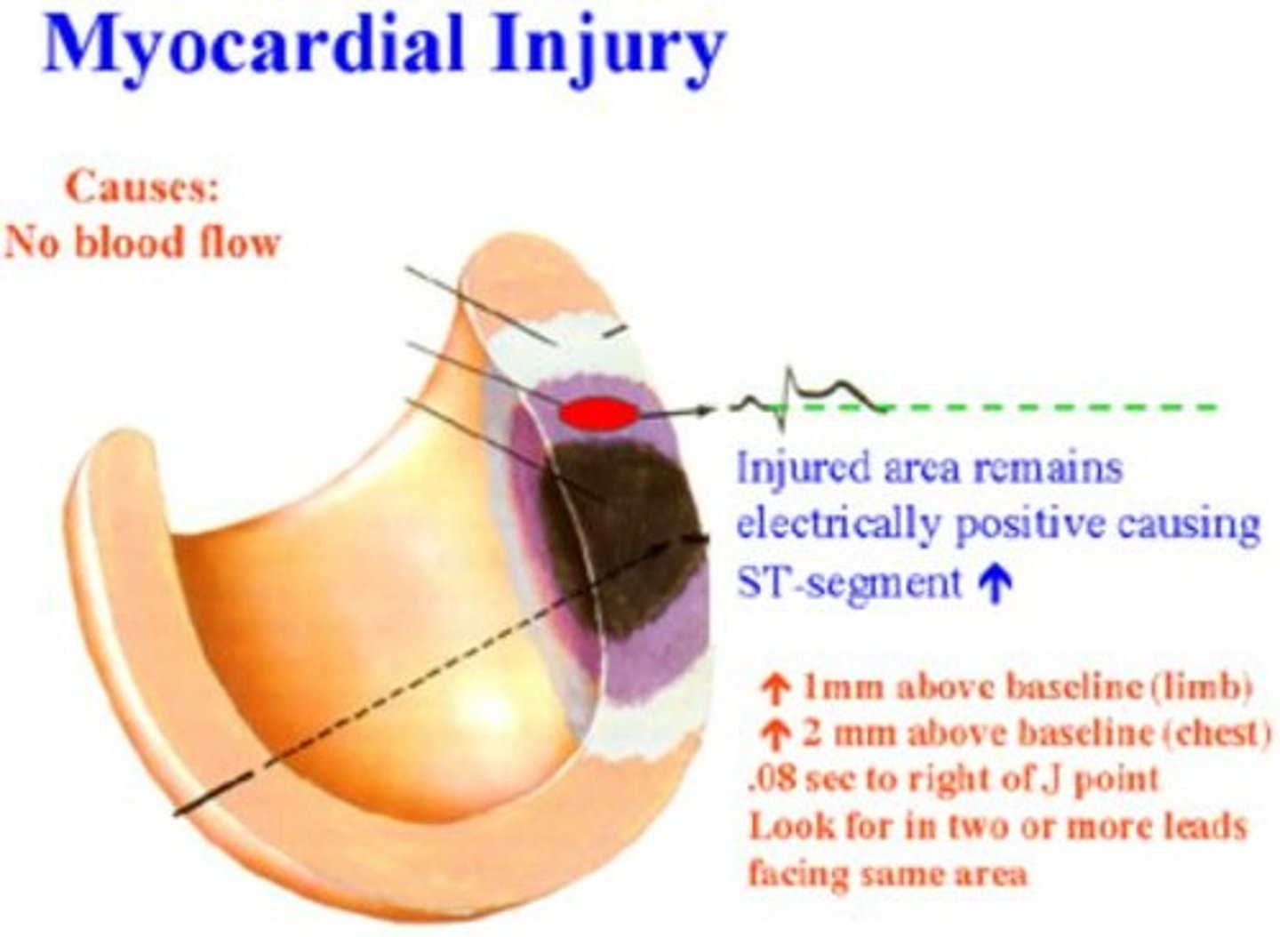 <p>Reperfusion strategies such as thrombolysis or primary PCI.</p>