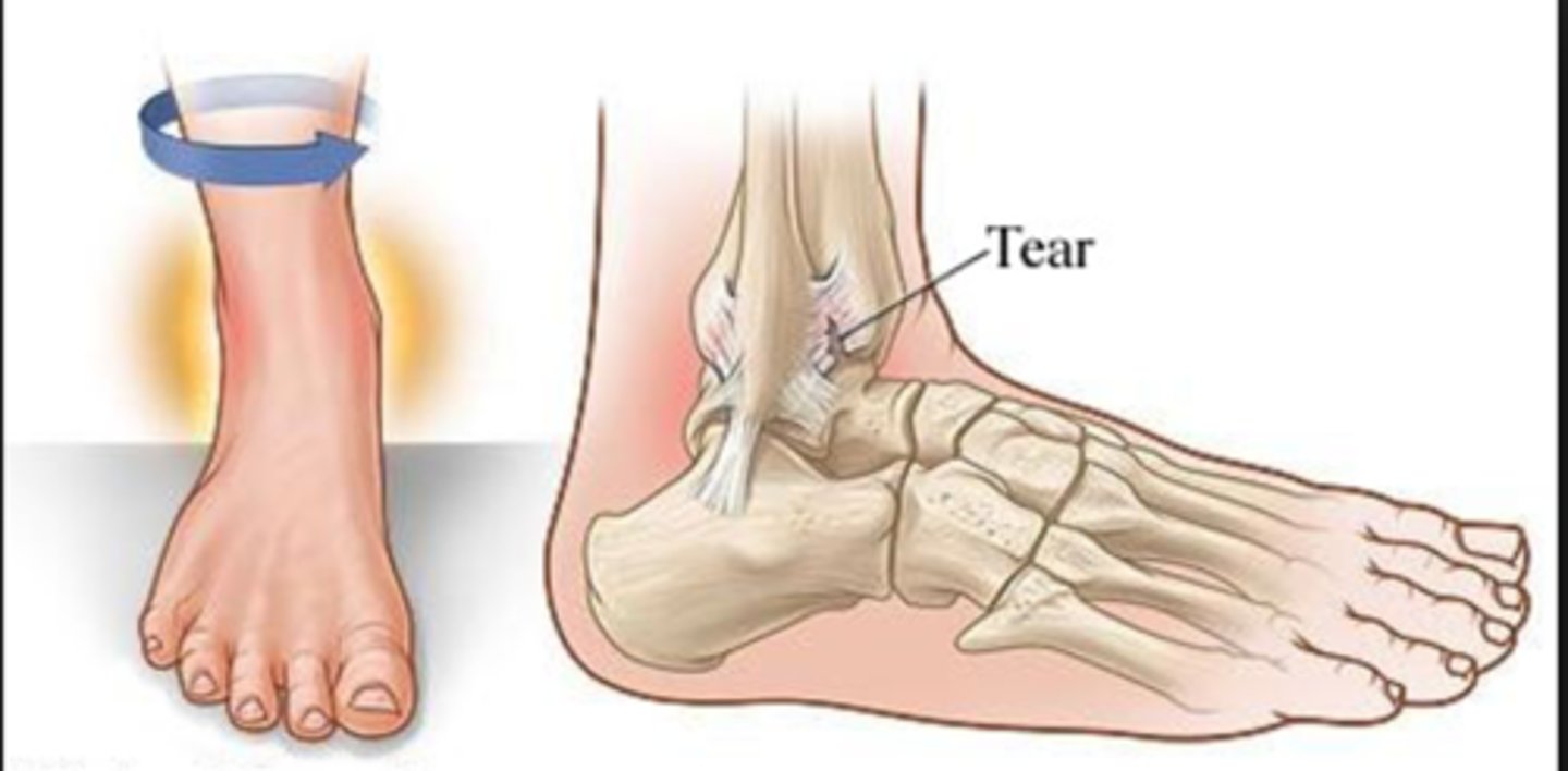 <p>a distal tibiofibular joint sprain</p><p>- presents with pain in outside-front of the leg above ankle, pain with applied rotational force with minimal swelling</p>