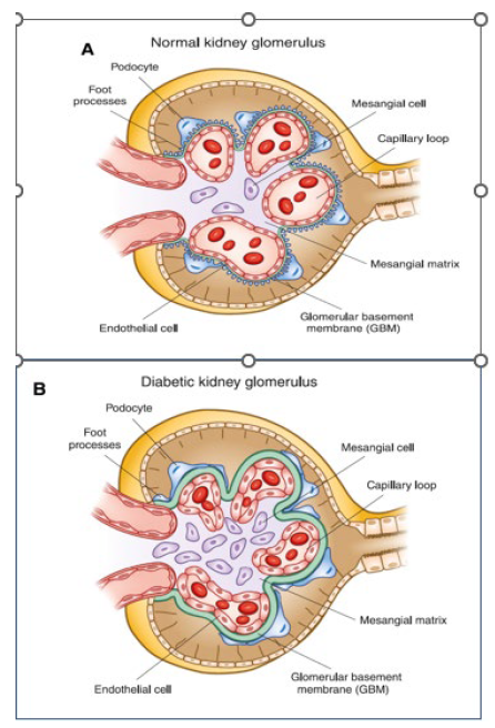 <ul><li><p>both symptomatic of advanced CKD and pathogenic</p><ul><li><p>lowering BP delays the rate of progression</p></li></ul></li><li><p>ACEIs/AT2RAs are generally the best agents (esp in diabetic nephropathy), CCB (dihydropyridine) are also preferred.</p></li><li><p>most patients will require at least 2 drugs, probably more</p></li><li><p>Key take home message: ACEis/ARBs are first line agents in patients with CKD but can also be nephrotoxic.</p></li><li><p>As long as kidney function does not deteriorate by more than 25% (eGFR) of baseline within 2 months of initiation they are ok to continue.</p></li><li><p>OR potassium does not exceed by 6mmol/L they are ok to continue. They are renoprotective in the long run</p></li></ul><p></p>
