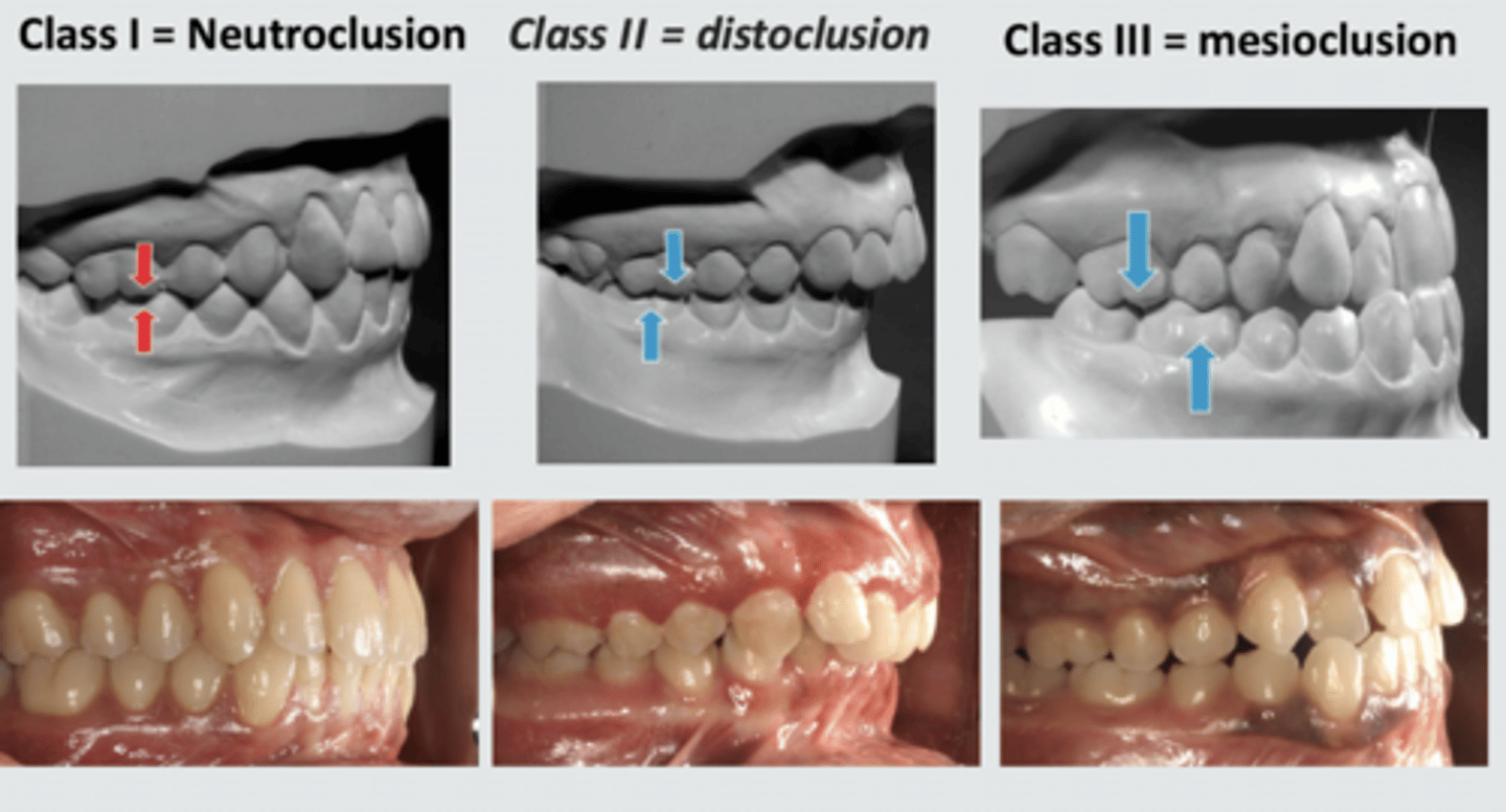 <p>class 1= neutrocclusion</p><p>class 2= distocclusion</p><p>class 3= mesiocclusion</p>