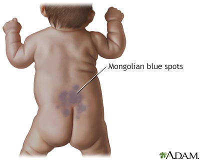 <p>flat, blue gray, birthmark that may appear on a baby (usually at the sacrum/buttock) at birth or shortly after</p>