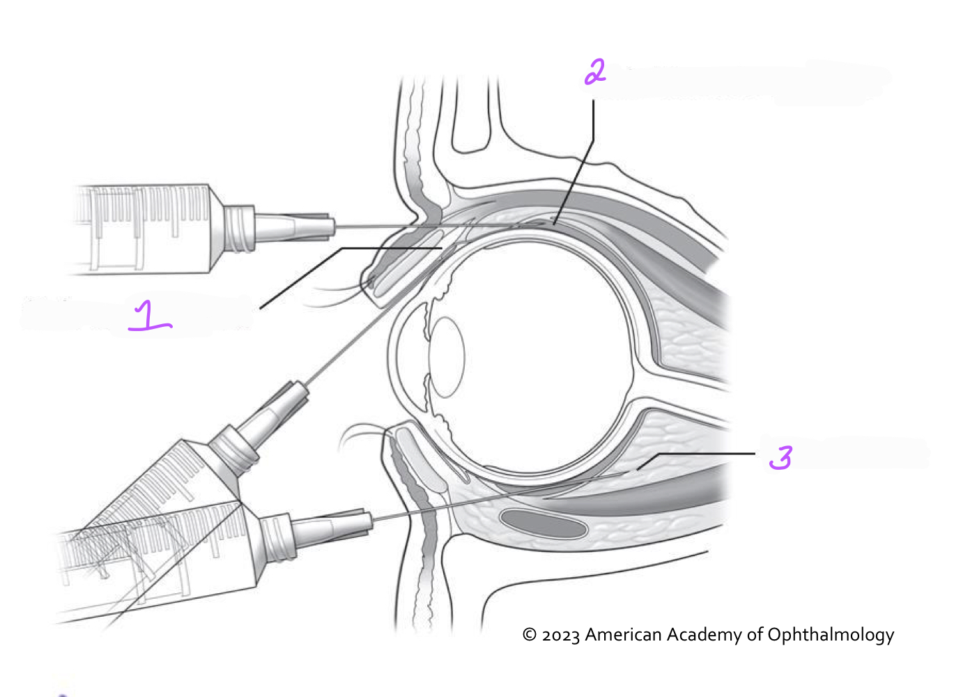 Identify the labeled methods of periocular drug administration in the figure.