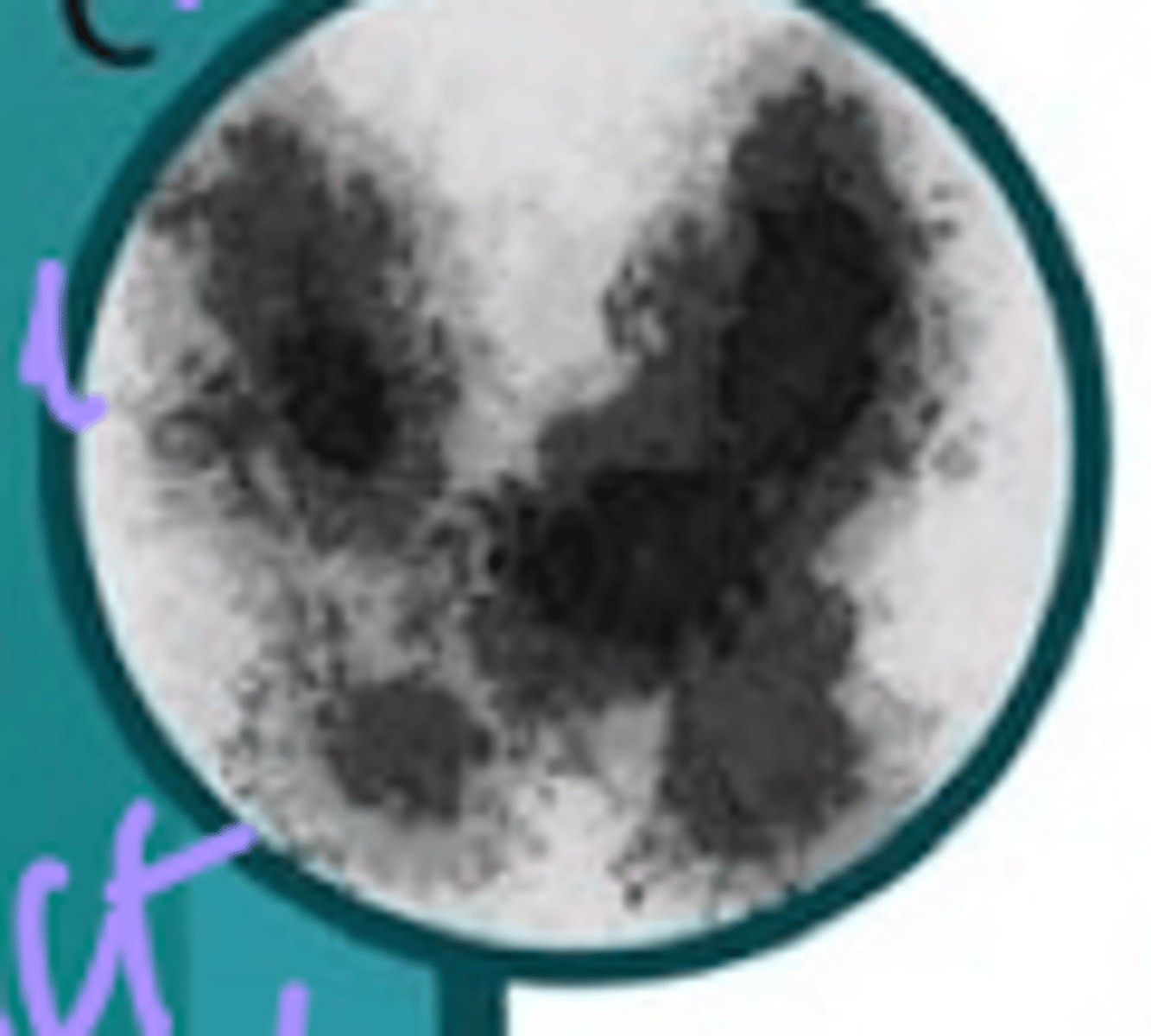 <p>Define Cause of Hyperthyroidism:</p><p>Autonomous nodules w/n thyroid gland --&gt; secrete excess TH (INDEPENDENT OF TSH REGULATION)</p><p>-Hx:</p><p>&gt; 2nd MCC of Hyperthyroidism (20%)</p><p>&gt; MC in WOMEN around 50 y/o</p><p>-Path: BENIGN!</p><p>&gt; D/t somatic mutation (occurring after fertilization) in thyroid cell --&gt; focal excess growth of functioning Thyroid tissue (activating mutation to gene for TSH receptor)</p><p>&gt; Longstanding, untreated hypothyroidism ==&gt; chronic elevation in TSH</p><p>-Sx:</p><p>&gt; Tremors</p><p>&gt; Palpitations</p><p>&gt; Anxiety</p><p>&gt; Diarrhea</p><p>&gt; Heat Intolerance</p><p>&gt; Wt Loss</p><p>&gt; Fatigue</p><p>-PE:</p><p>&gt; Tachycardia</p><p>&gt; Systolic HTN w/ widened pulse pressure</p><p>&gt;&gt; High SBP d/t increased cardiac output</p><p>&gt;&gt; Low DBP d/t less PVR</p><p>&gt; Wt Loss</p><p>&gt; Eyelid Lag (abnormally raised upper eyelid d/t SNS hyperactivity --&gt; still see sclera when they look down)</p><p>&gt; PALPABLE NODULE of Thyroid Gland</p><p>-Dx:</p><p>Labs</p><p>&gt; TSH = Low</p><p>&gt; Free T4 and/or Total T3 = High</p><p>Thyroid US = Nodules</p><p>Radioactive Iodine Uptake Scan (CONFIRM)</p><p>&gt; High = LOTS of new TH (focal hyper-functionality)</p><p>-Tx:</p><p>&gt; Thionamides = Methimazole, PTU (Antithyroid)</p><p>&gt; Thyroidectomy --&gt; Life time Levothyroxine</p><p>&gt; Radioactive Iodine Ablation --&gt; Life time Levothyroxine</p>