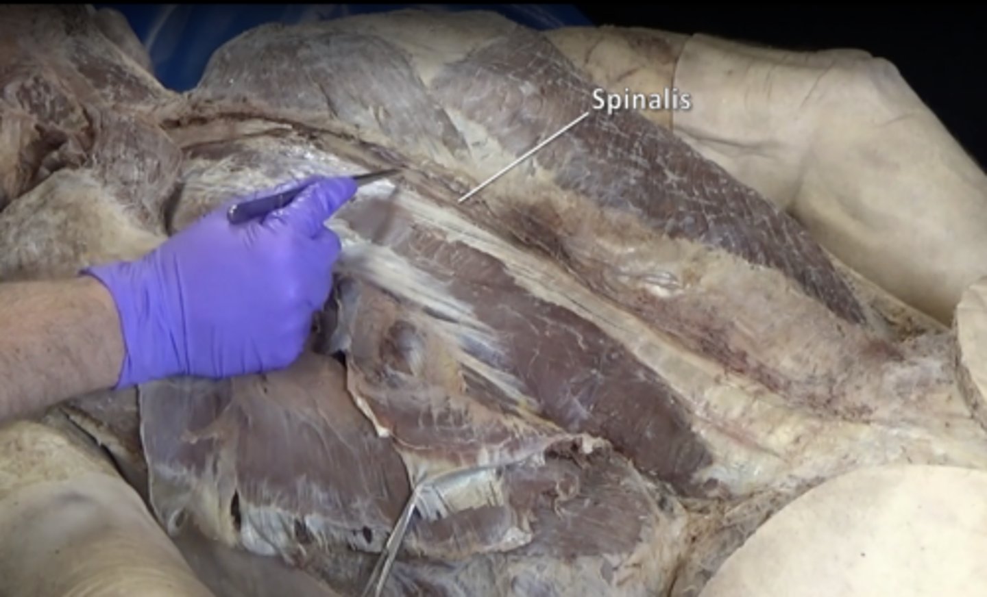 <p>Smallest and most medial of erector spinae group</p>