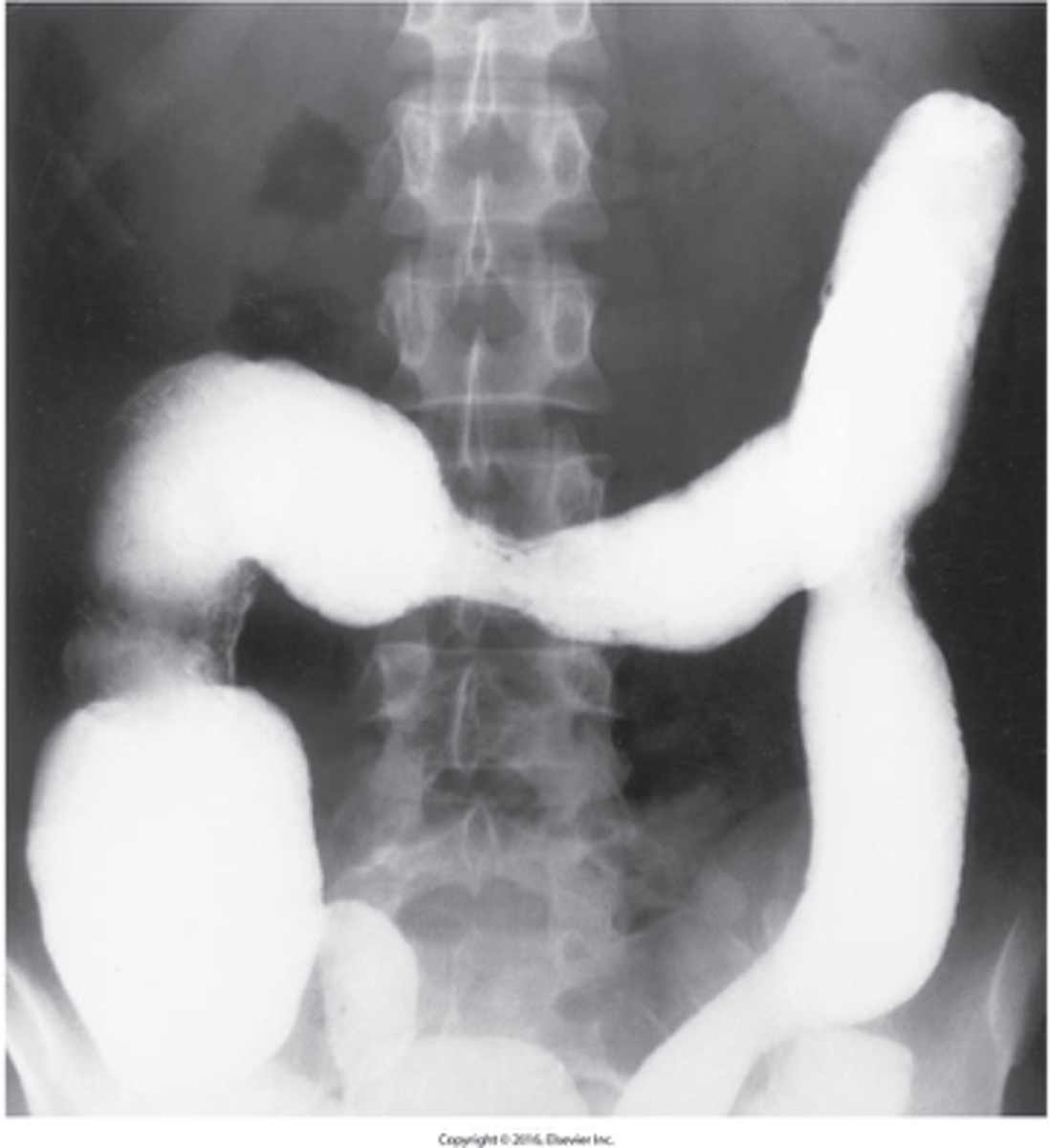<p>What can Ulcerative colitis be described as not an X-ray ?</p>