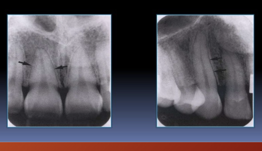 <p>periodontal ligament space - primarily composed of collagen - appears as radiolucent space between root and lamina dura</p>
