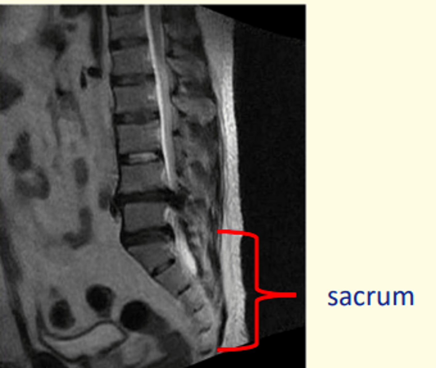 <p>5 fused vertebra at the base of the spine (S1-S5)</p><p>Articulates with the pelvis laterally</p>