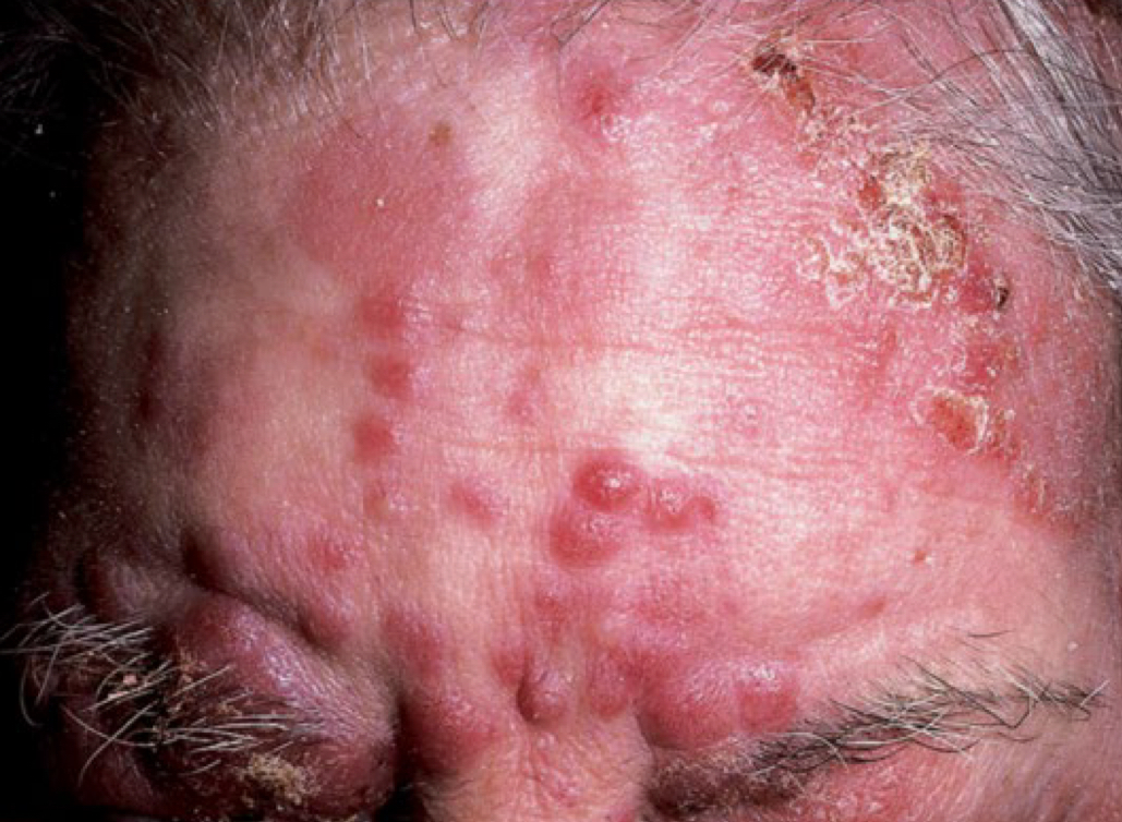 <p>what lesion is depicted</p>