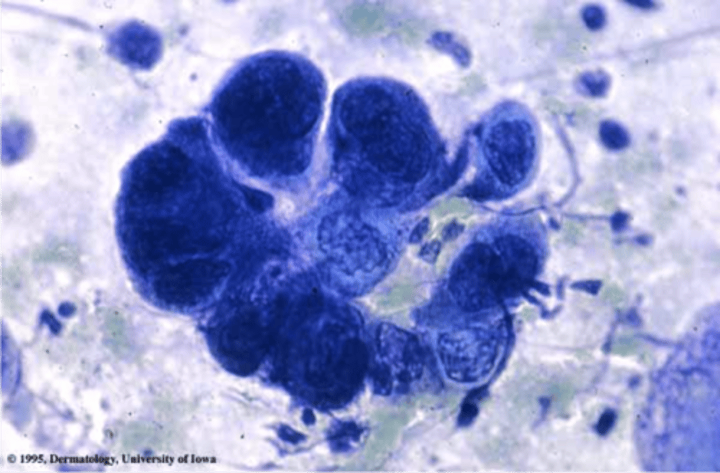 <p>Tzanck smear stain - multinculeated giant cells</p>