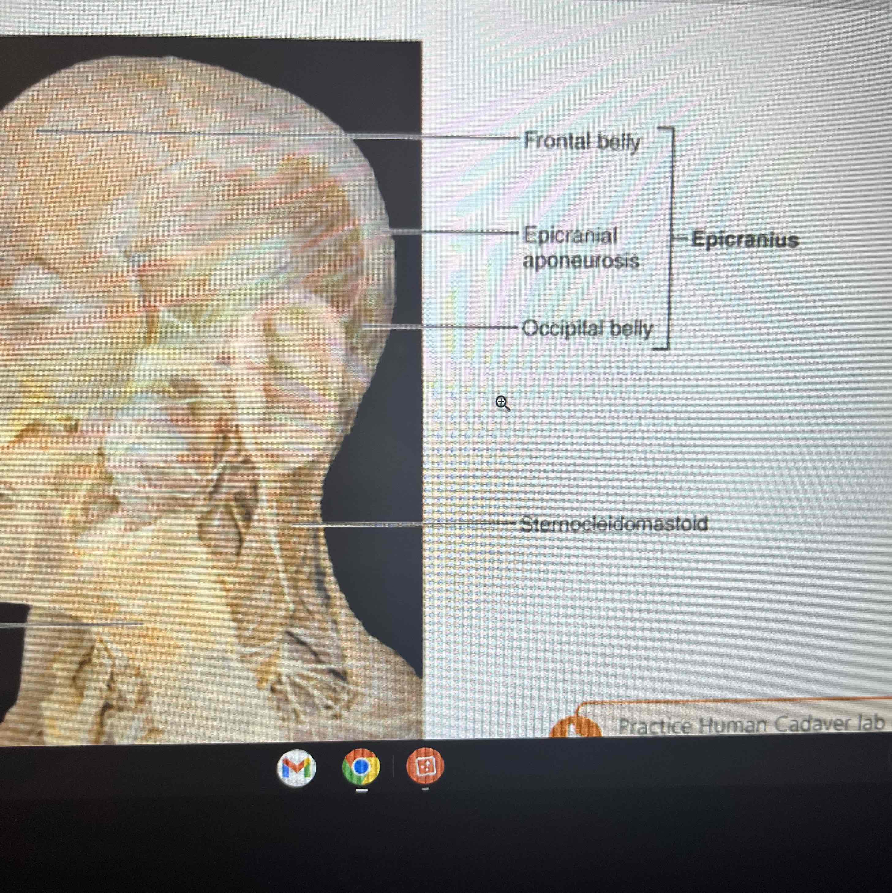<p>1) frontal belly: O: epicranial aponeurosis I: skin of eyebrows and root of nose A: raise the eyebrows</p><p>2) occipital belly: O: occipital and temporal bones I: epicranial aponeurosis A: fixes aponeurosis and pulls scalp posteriorly</p><p>Epicranial aponeurosis (CT) connects the occipital with the frontal</p>