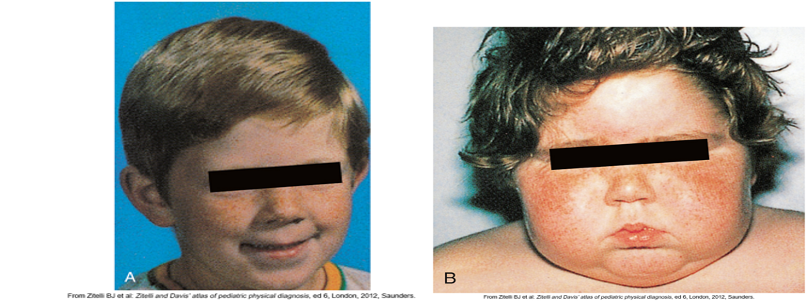 <p>•<span>Hypercortical function: </span></p><p></p><p>•<span>Cushing syndrome- manifestations resulting from chronic excess cortisol, regardless of cause</span></p><p>•<span>Cushing disease- excessive anterior </span><u><span>pituitary</span></u><span> secretion of ACTH</span></p><p>•<span>Manifestations: </span></p><p>-<span style="color: yellow">Weight gain in trunk (“truncal obesity”)</span></p><p><span>-</span><span style="color: blue">facial (“moon face”)</span></p><p><span>-</span><span style="color: red">cervical areas (“buffalo hump”)</span></p><p><span style="color: green">•Glucose intolerance &amp; protein wasting</span></p><p></p>