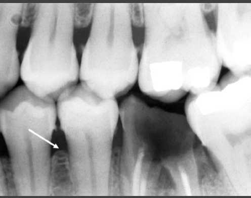 <ul><li><p>Areas of localized erosion of interproximal alveolar crest</p></li><li><p>Anterior: blunting of crests and mild loss of bone height</p></li><li><p>Posterior: loss of sharp angle between crest and lamina dura</p><ul><li><p>Angle may appear “rounded off” with a more irregular border</p></li></ul></li><li><p>Cortical surface of bone edge may become more diffuse</p></li><li><p>Radiographic evidence of bone loss follows disease onset</p><ul><li><p>Takes ~ 6-8 months of disease progression until radiographic bone loss evident</p></li></ul></li></ul><p></p>