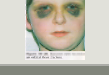 <p>raccoon eye</p>