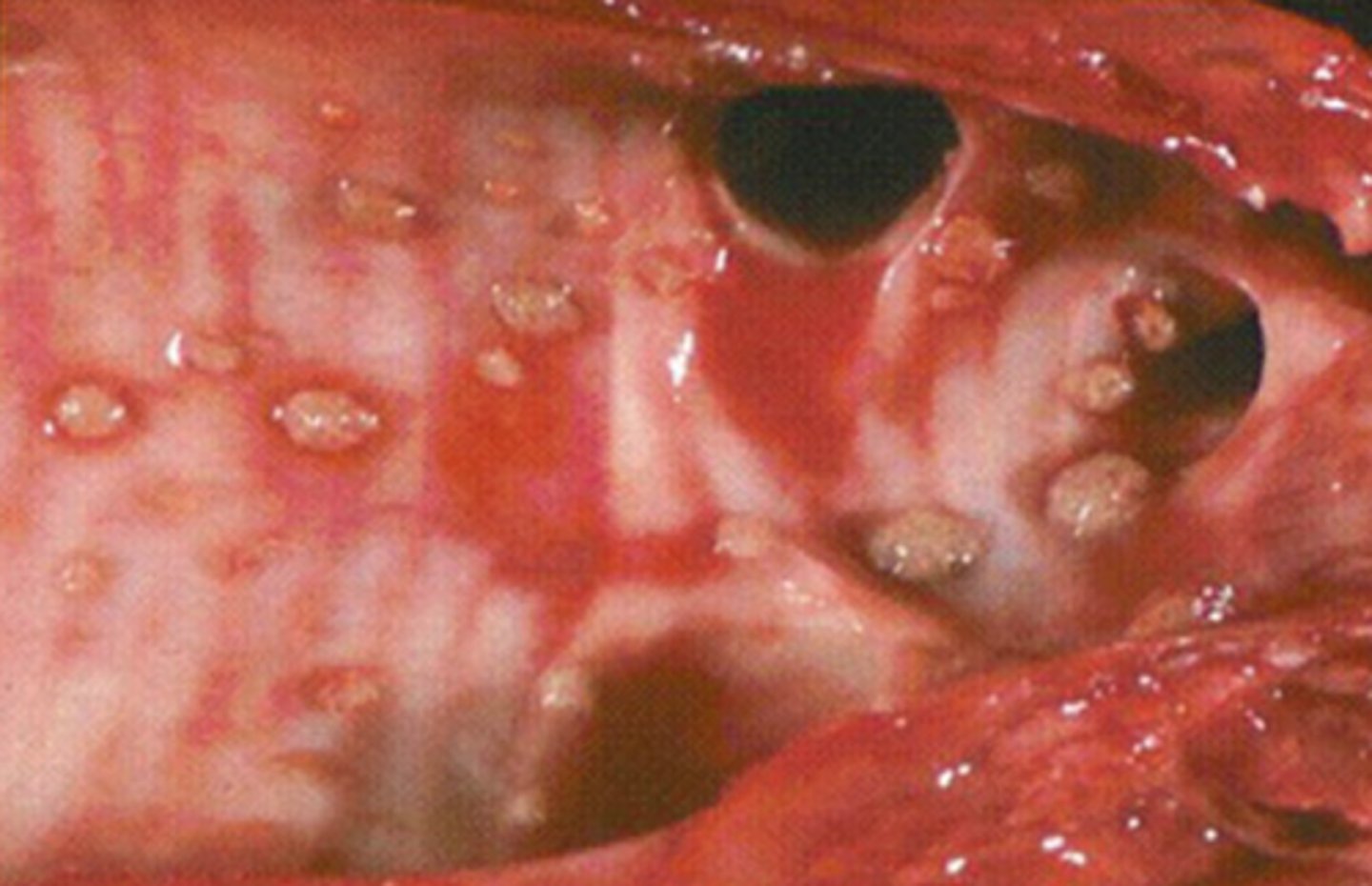 <p>tracheal worm</p><p>nodules on bronchoscopy</p><p>tx = ivermectin</p>