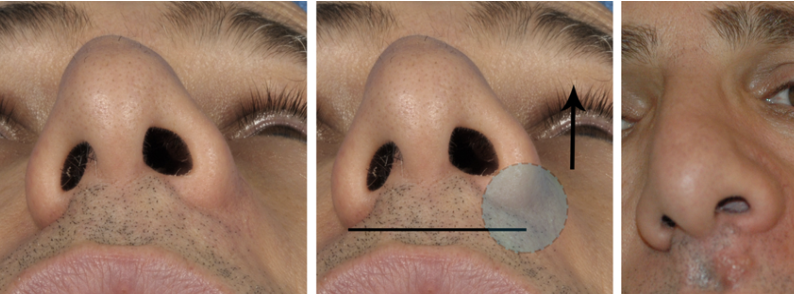 <p>Dit is een cyste in de lip die odontogeen is, hij komt dus niet van de tanden of kiezen vandaan. Als een patiënt erge last heeft, wordt dit verwijderd.&nbsp;</p>