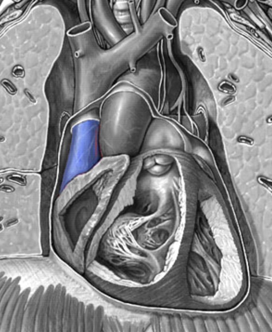 <p>Which veins:</p><ul><li><p>Directly superior to right atrium</p></li><li><p>Brings deoxygenated blood from upper body to right atrium</p></li></ul><p></p>