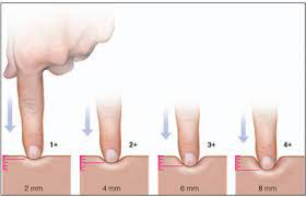 caused by poor circulation or fluid retention. 