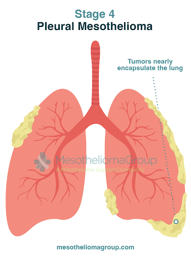 <p>cancer of the mesothelium (like a tumor)</p><p>ex: in lungs, testes, heart, abdomen linings</p><p></p>
