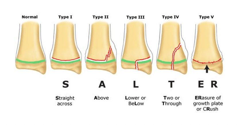 Salter-Harris fractures 