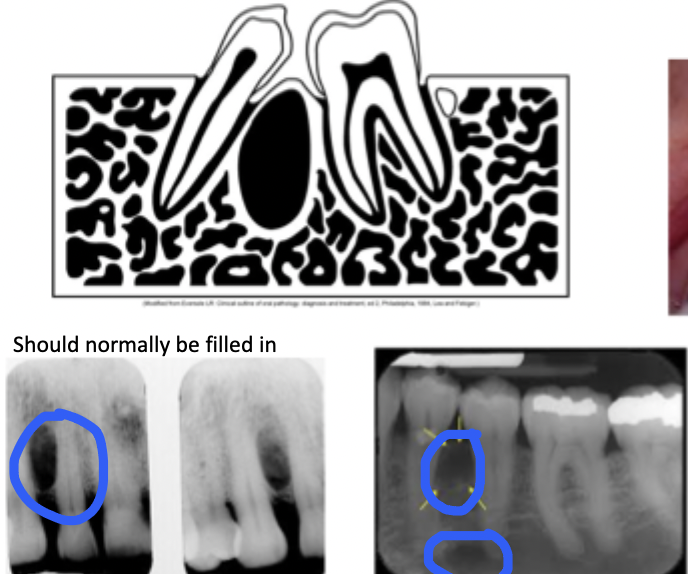 <p>Area between the roots of adjacent teeth like lateral periodontal cyst. </p>