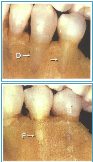 <ol><li><p>fenestration: exposed root due to absence of lingual/buccal alveolar bone lamina </p></li><li><p>dehiscence: roots extending through marginal bone </p></li></ol><p></p>