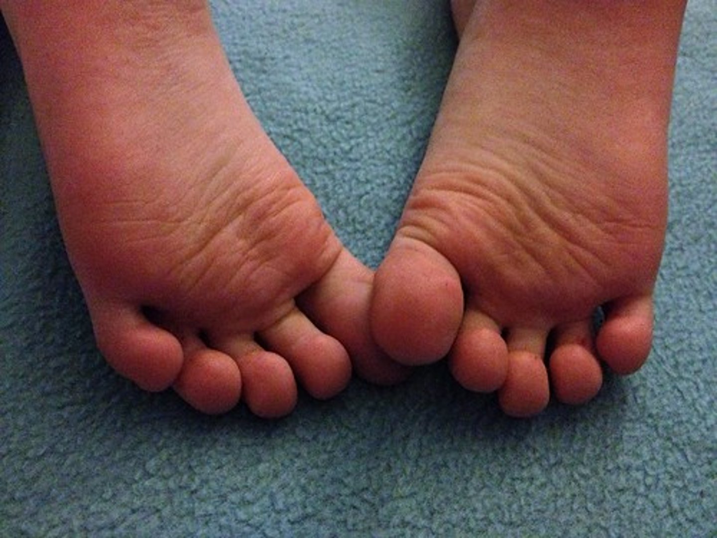 <p>Sole of foot</p>