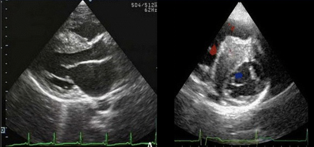 <p>Which of the following valvular abnormalities is commonly associated with the abnormality on the image? </p>